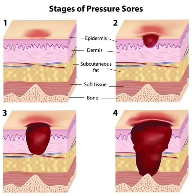 Comprehensive Guide to Bedsores: Causes, Symptoms, Treatment, and Prevention